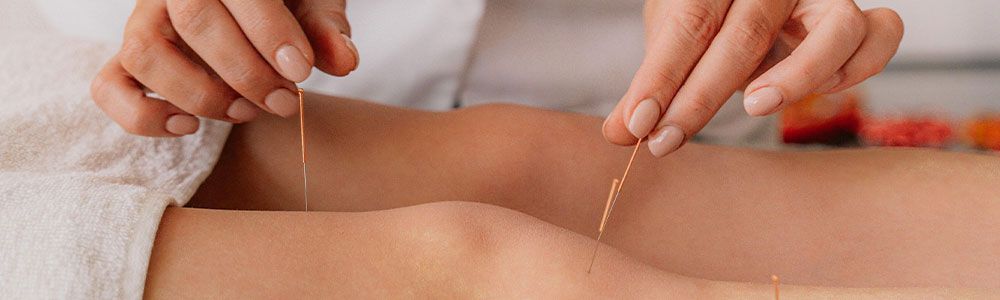 Acupuncture on legs