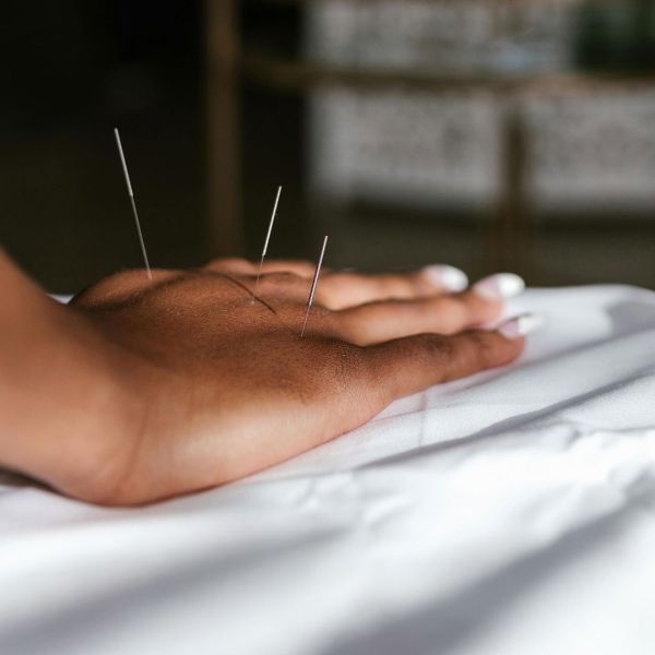 Acupuncture treatment on hand